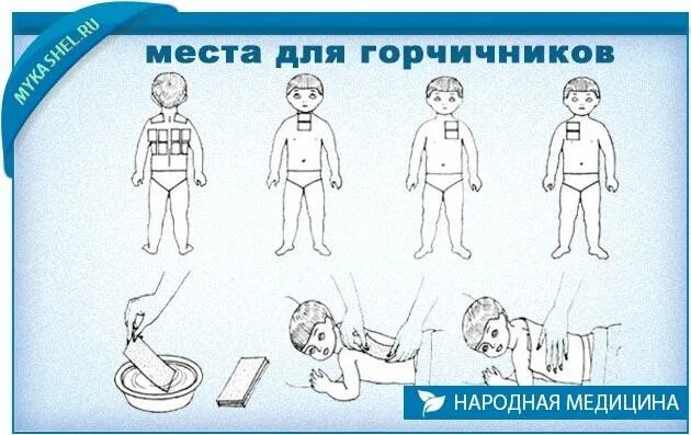 Как ставить горчичники при кашле детям. Горчичники при кашле детям. куда ставить горчичники р. как правильно поставить горчичники ребенку. куда ставить горчичники при кашле ребенку.
