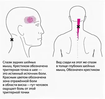 Головная боль от спазма