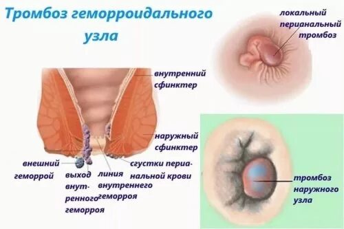 Как выглядит анус после анального 8 Gejala Akalasia Yang Harus Diwaspadai Dan Cara Mengobatinya Minuman
