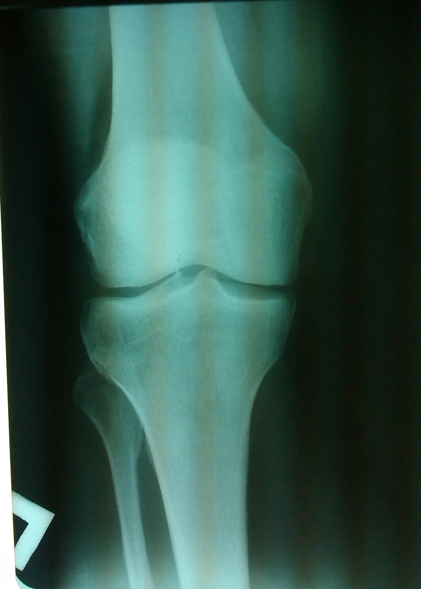 Трещина в коленной. Болезнь Гоффа коленного сустава рентген. Здоровый коленный сустав рентгеновский снимок. Рентген колена с переде. Рентген здорового коленного сустава.