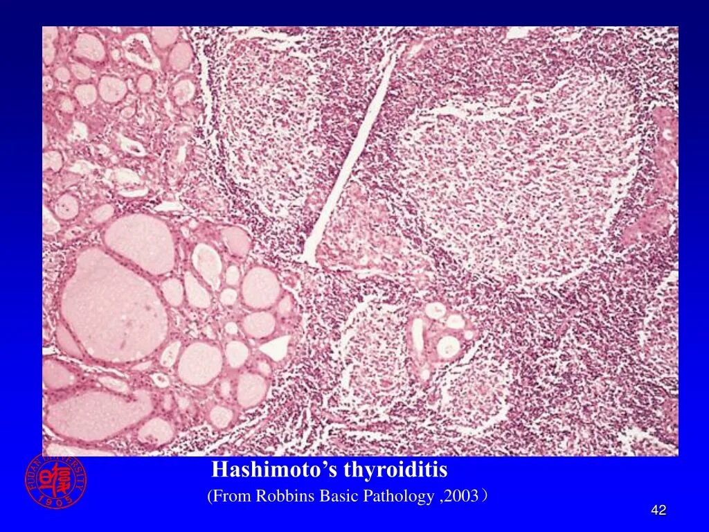 Тиреоидит Хашимото патанатомия. Тиреоидит Хашимото препарат. Аутоиммунный тиреоидит микропрепарат. Аутоиммунный тиреоидит Хашимото микропрепарат. Лимфоцитарный тиреоидит