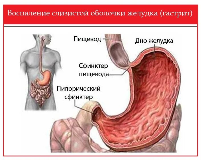 Желудочный сок в пищеводе