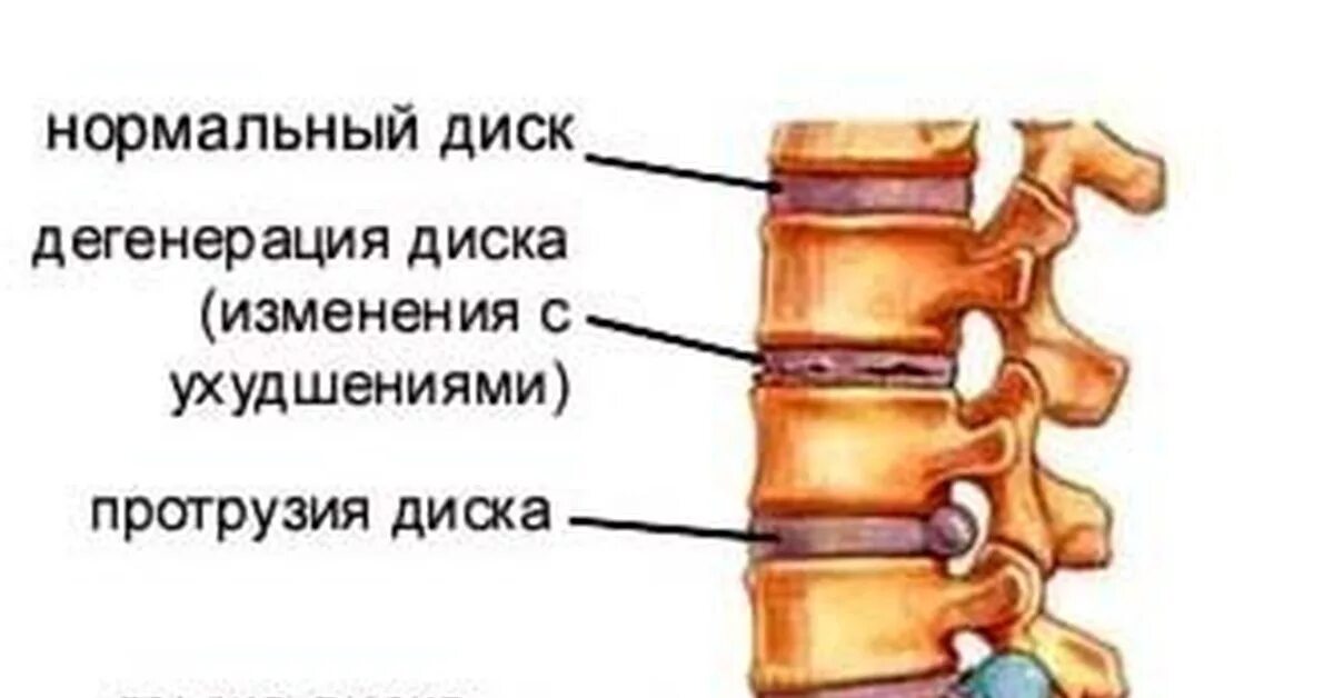 Грыжа позвоночника экструзия. Протрузия межпозвонковых дисков. Экструзия и протрузия межпозвоночного диска. Грыжа диска и протрузия диска.