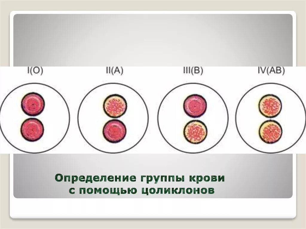 Исследование групп крови человека. 3 Отрицательная группа крови под микроскопом. Определение группы крови. Группа крови Цоликлоны.