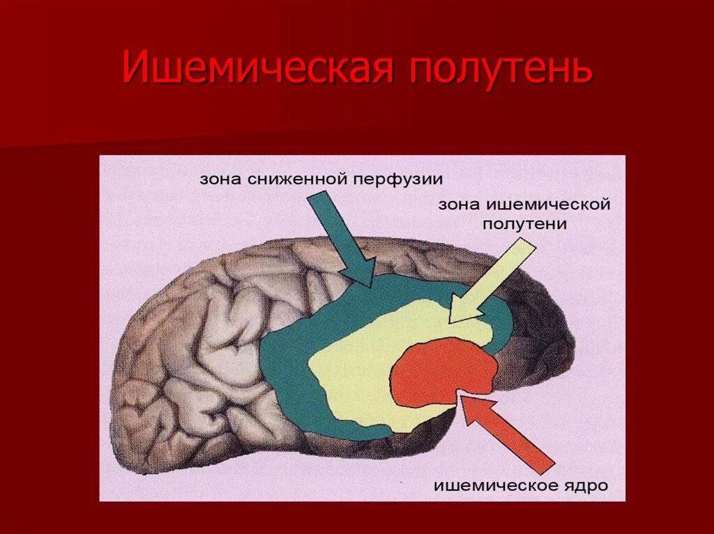 Ишемической полутени (Пенумбры). Ишемический инсульт Пенумбра. Пенумбра зона ишемической полутени.