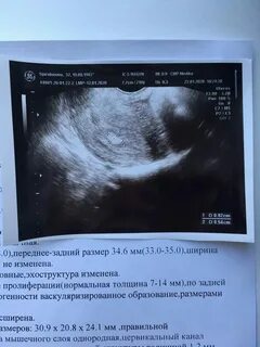 Гормональный полип в матке