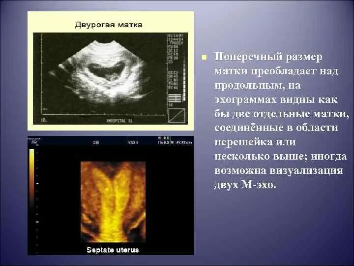 Почему пульсирует матка. Двурогая матка по УЗИ протокол. Двурогая матка на УЗИ. Двурогая матка и беременность УЗИ. Двурогая матка на УЗИ описание.