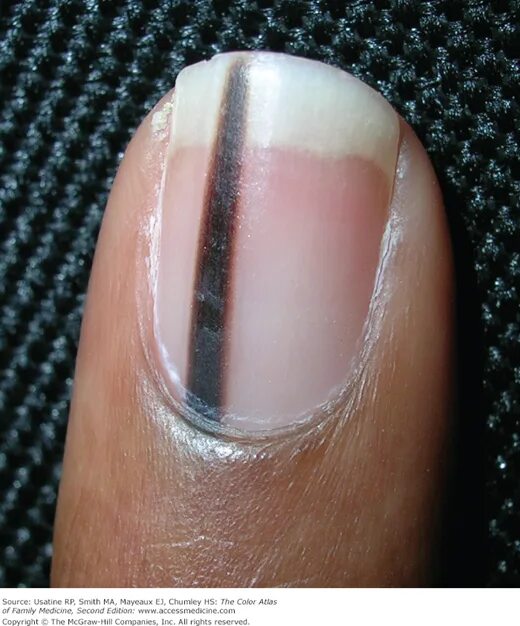 Полоски на ногтях причины вертикальные у женщин. Подноктевавая меланома. Продольная меланонихия.