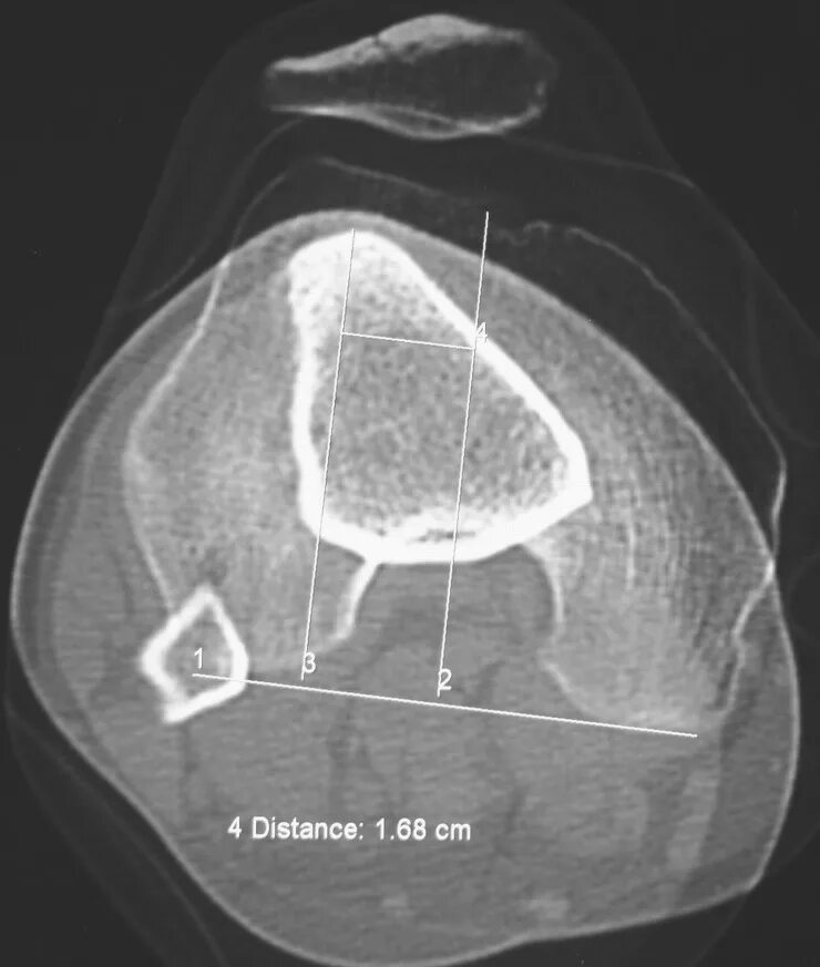 Латерализация надколенника. Рентгенография надколенника в аксиальной проекции. Латерализации надколенника кт. Индекс TT-TG.