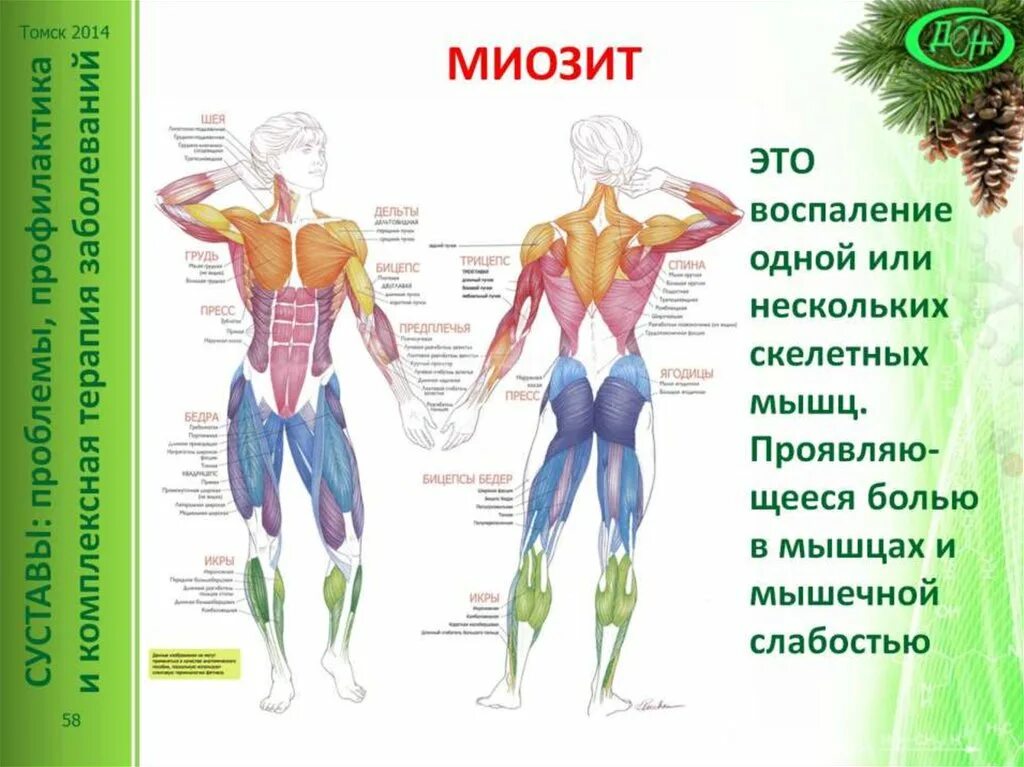 Миозит что это. Воспаление мышц миозит. Воспаление скелетных мышц – миозит;.