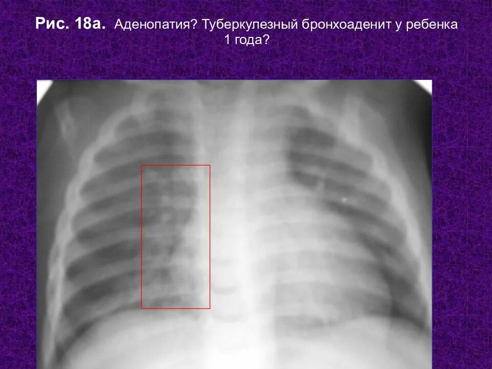 Туберкулезный бронхоаденит. Туберкулёзный бронхоаденит на рентгенограмме. Аденопатия