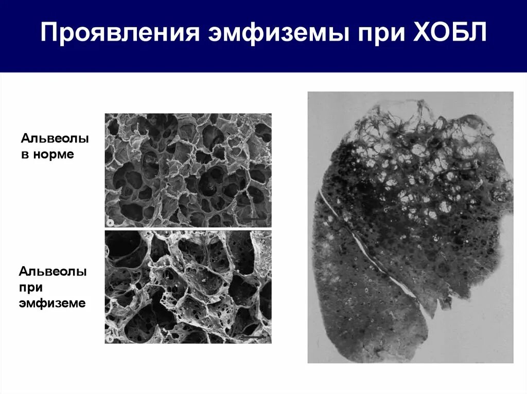 Вылечить эмфизему легких. Кожные покровы при эмфиземе легких.