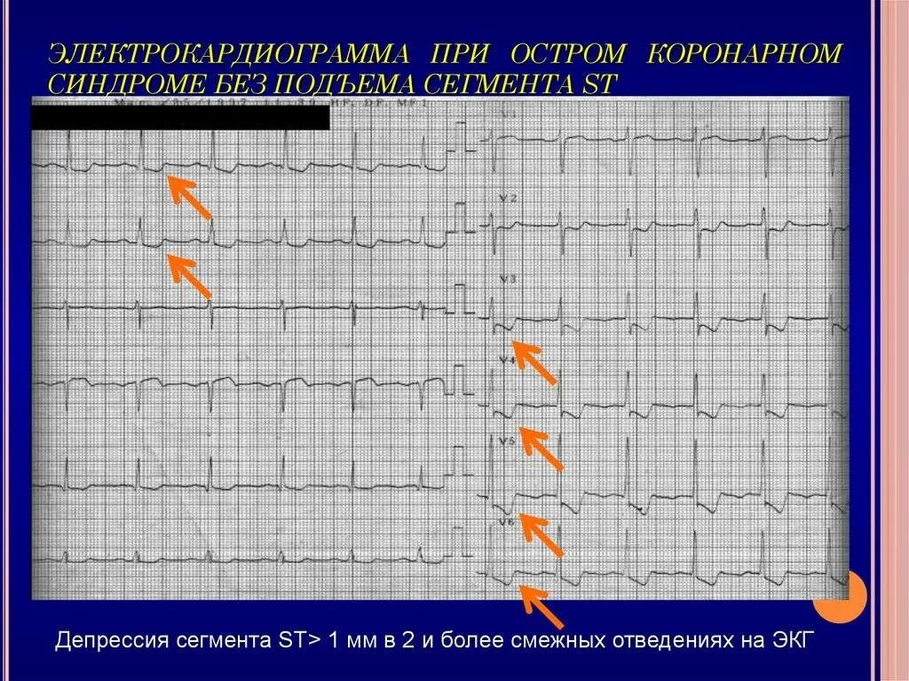 Без подъема st на экг. Окс без подъема сегмента ст ЭКГ. Инфаркт миокарда с подъемом сегмента St ЭКГ. ЭКГ при инфаркте миокарда без подъема сегмента St. Окс без подъема St на ЭКГ.