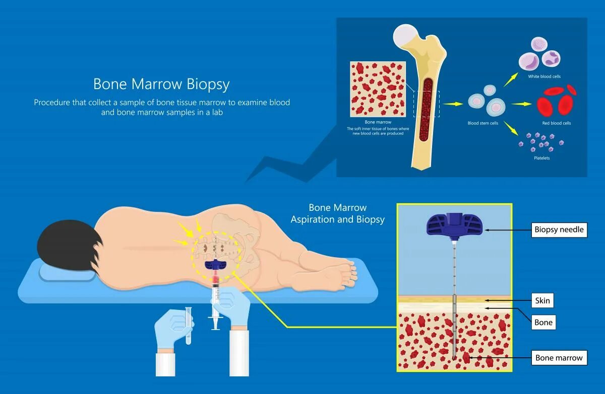Трансплантация костного мозга. Трансплантация стволовых клеток костного мозга. Трансплантация костного мозга картинки. Трансплантация костного мозга рисунок. Пересадка костного мозга что это