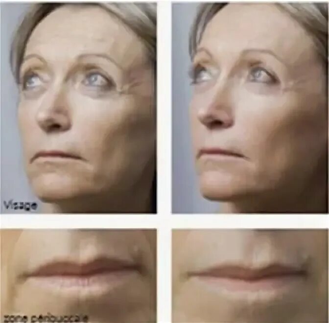 Nctf 135 отзывы фото до и после Filorga Nctf 135 Ha Anti Ageing Mesotherapy 5 Filling Treats Hebei Kouxuan Tec