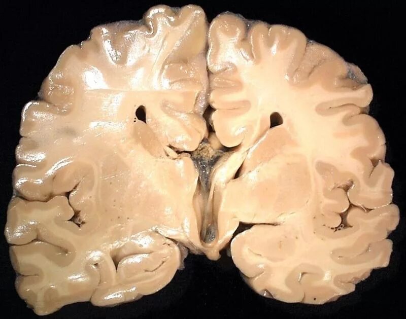 мр расширения наружных ликворных пространств. мр расширения наружных ликворных пространств. очаг в лобной доли. мр расширения наружных ликворных пространств. расширение наружных ликворных пространств на кт.