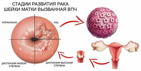 Вирус папилломы гинекология как передается