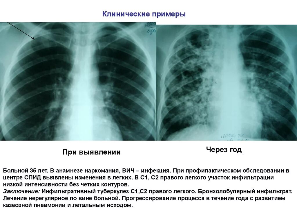 Инфильтративный туберкулез легкого с1-2. Инфильтративный туберкулез рентген. Очагово-инфильтративный туберкулез рентген. Туберкулез в с2 левого легкого. Очаговых изменений правого легкого