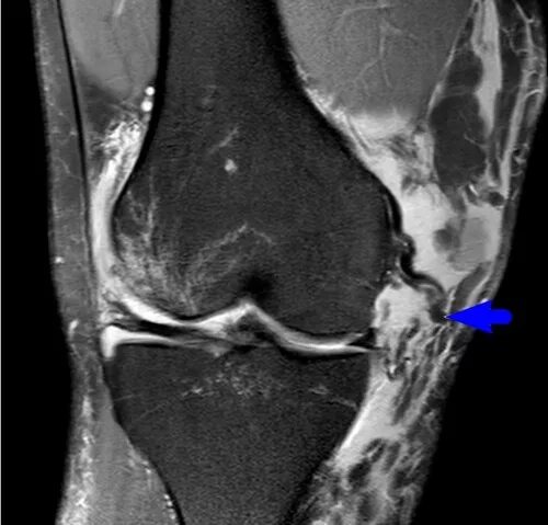 Показать разрыв. Анзериновый бурсит коленного сустава на мрт. Разрыв большеберцовой коллатеральной связки мрт. Синовиома коленного сустава. Разрыв латеральной коллатеральной связки мрт.