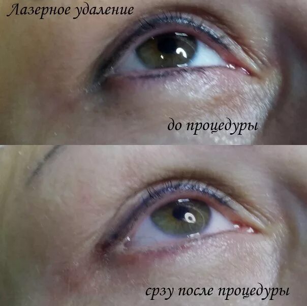 удаление татуажа век отзывы