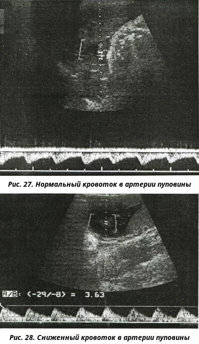 Сма плода. Допплерография маточно-плацентарного кровотока. УЗИ допплерография маточно-плацентарного кровотока. Допплерометрия кровотока пуповины. . Допплерометрия маточно- и фетоплацентарного кровотока.