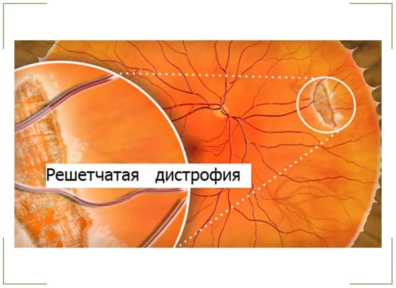 Кистевидная дистрофия сетчатки. Дегенерация сетчатки булыжная мостовая. Макулодистрофия сетчатки глаза что это такое. Белоточечная абиотрофия сетчатки. Дистрофия клетчатки.