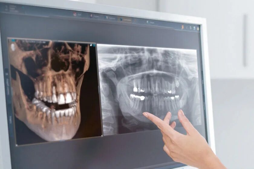Дентальная 3 д томография. Компьютерная томография зубов. Кт д т