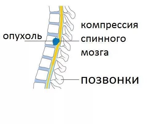 . Причина компрессии Корешков спинного мозга. Сдавление спинного мозга. Опухоль спинного мозга грудного отдела.