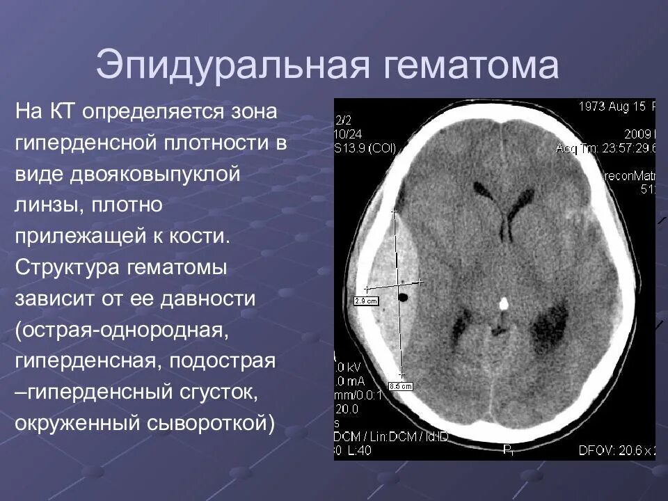 Травматических повреждений мозга. Субдуральная и эпидуральная гематома кт. Кт признаки эпидуральной гематомы. Кт эпидуральной и субдуральной гематомы. Хроническая эпидуральная гематома кт.