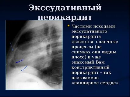 Панцирное сердце