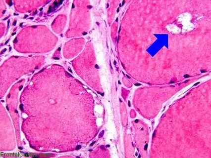 Myositis латынь