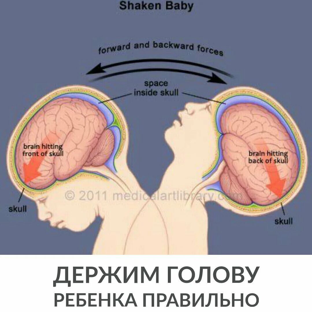 Почему нельзя трясти. Синдром встряхивания ребенка. Синдром детского сотрясения. Синдром встряхнутого младенца. Синдром детского сотрясения признаки.