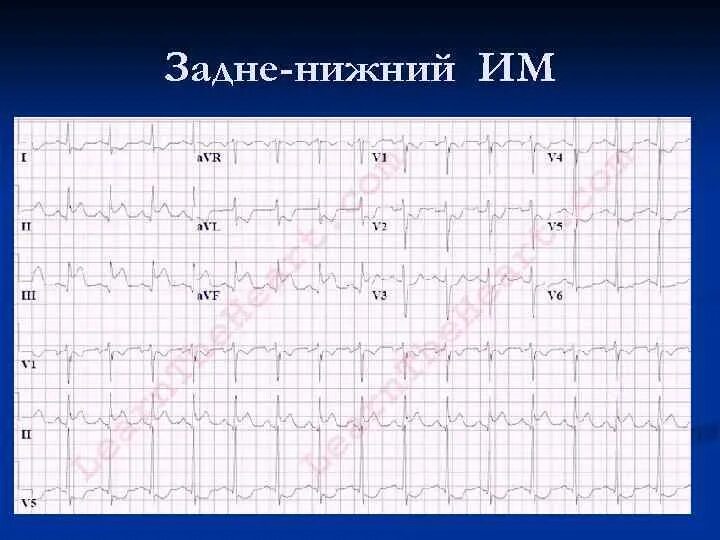 Диффузные изменения миокарда на ЭКГ. Метаболические изменения на ЭКГ. Дистрофические изменения на ЭКГ. ЭКГ после нагрузки фото. Диффузные изменения экг что это значит