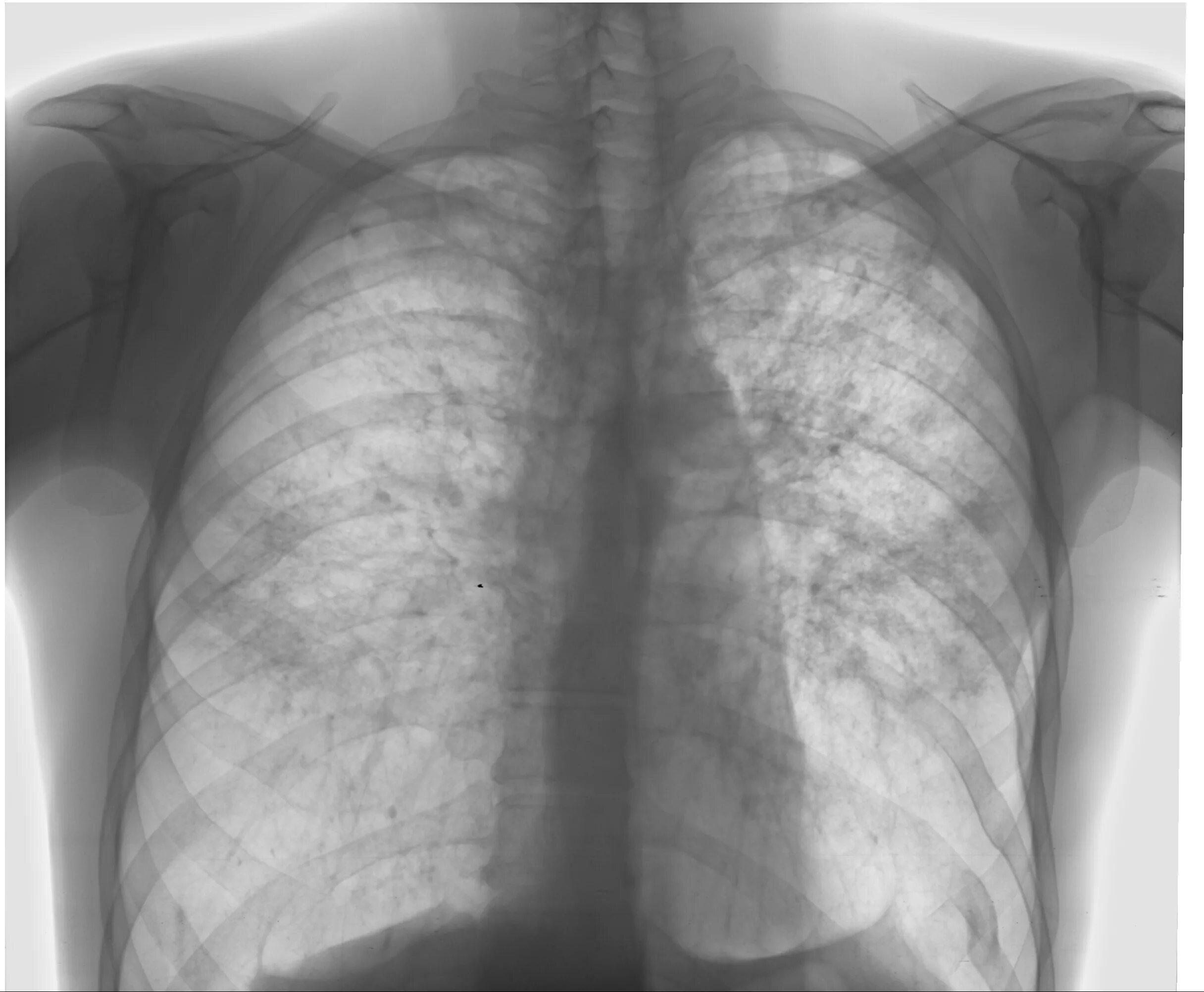 Легкие человека с туберкулезом. Диссеминированный туберкулез рентген. Внелегочный туберкулез рентген.
