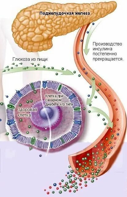 Восстановить поджелудочную железу при диабете. Сахарный диабет поджелудочная железа. Сахарный диабет при панкреатите. Искусственная поджелудочная железа для диабетиков 1 типа. Поджелудка и сахарный диабет.