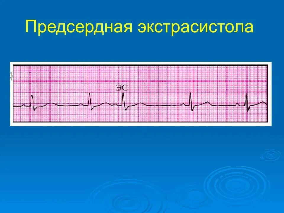 10 экстрасистола