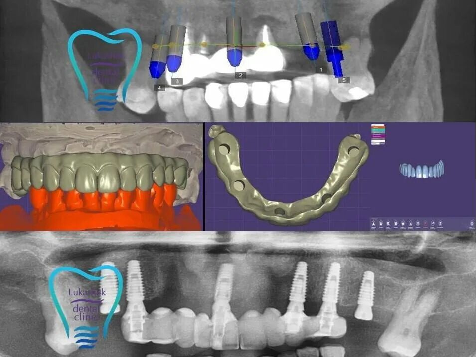 Зубы импланты поэтапно. Одноэтапная дентальная имплантация. Одномоментная имплантация. Этапы имплантации зубов.