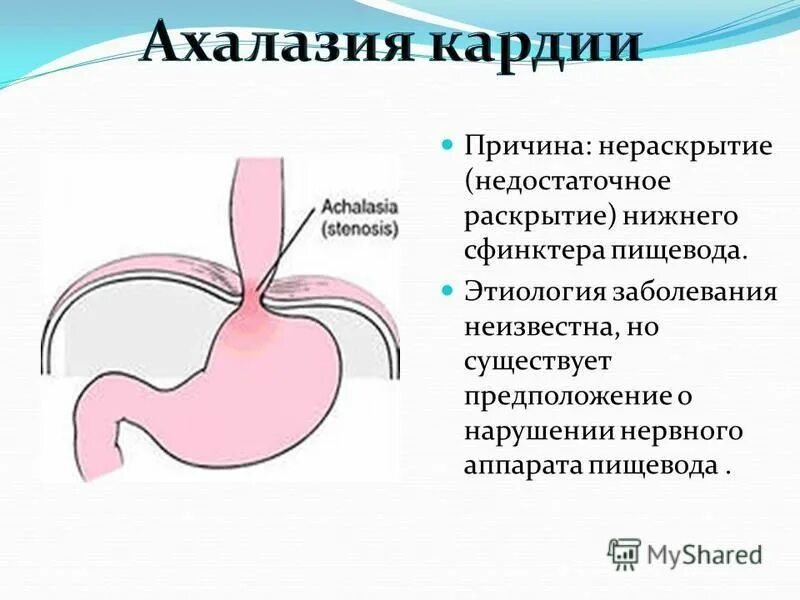 Признаки кардии желудка. Нижний эзофагеальный сфинктер. Нижний пищеводный сфинктер. Нижний пищеводный сфинктер смыкается.