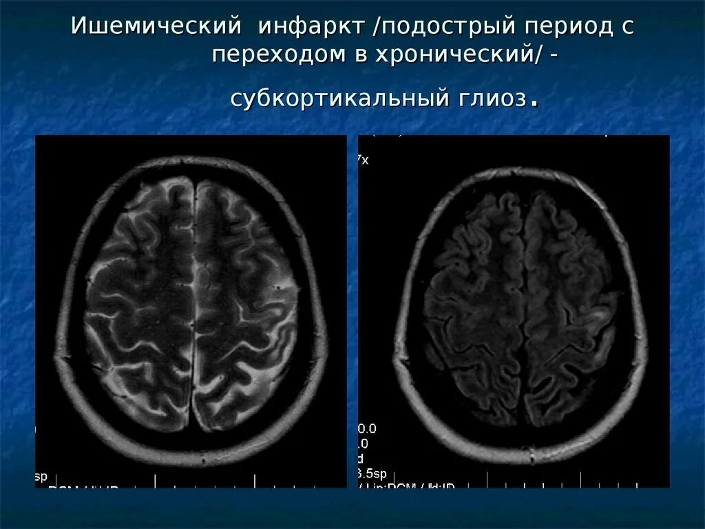 Глиоз в лобной доле головного мозга