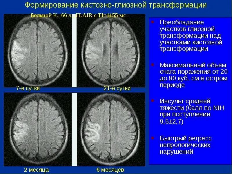 Глиозные изменения лобной доле