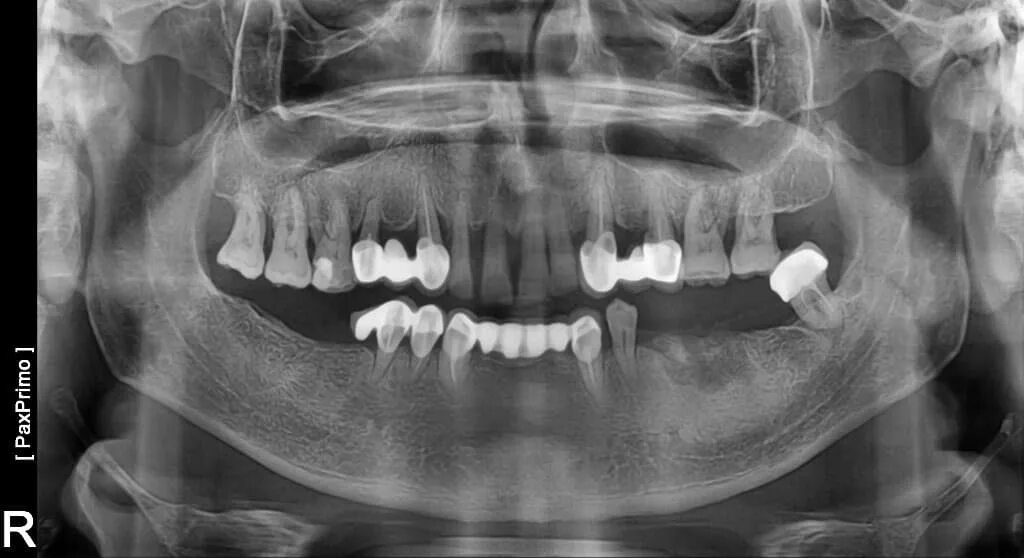 Снимок зубов видное. Остеомиелит челюсти ОПТГ. Ортопантомограмма пародонтит. Ортопантомограмма кариес. Генерализованный пародонтит ОПТГ.