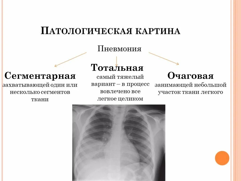 Очаговое поражение легких. Полисегментарная и долевая пневмония. Тотальная правосторонняя пневмония рентген. Правосторонняя очаговая пневмония рентген. Очаговая сегментарная пневмония.