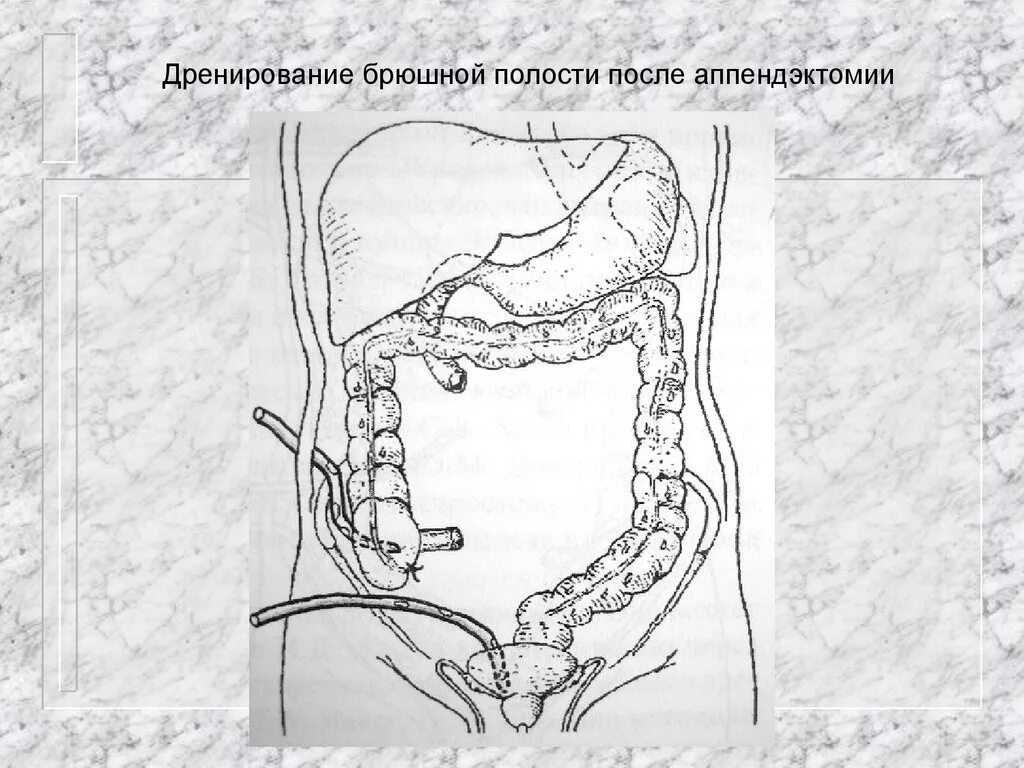 Аппендэктомия послеоперационный. Дренирование брюшной полости аппендицит. Дренирование брюшной полости по Генералову. Дренирование брюшной полости после аппендэктомии. Дренаж брюшной полости при аппендиците.