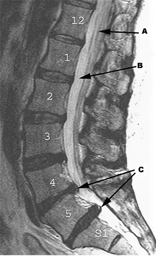 Протрузия дисков l2 l3 l4 l5. Грыжа l5-s1. Диск l5 l6. Грыжа l1-l4. Грыжеобразование l3/4, l 4/5, l5/s1.