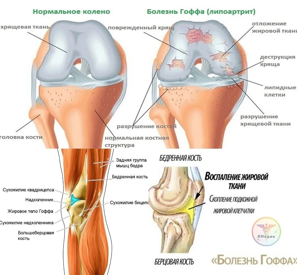 Болезнь гоффа как лечить. Липоартрит гоффа коленного сустава. жировая подушечка гоффа. жировое тело гоффа коленный сустав. болезнь гоффа коленного сустава.