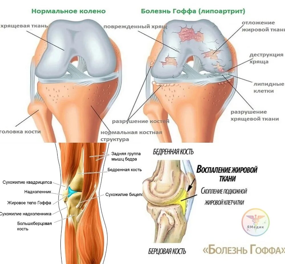 Отек гоффа коленного сустава. Липоартрит Гоффа коленного сустава. Клетчатка Гоффа коленного сустава. Суставное тело Гоффа. Жировая подушечка Гоффа.