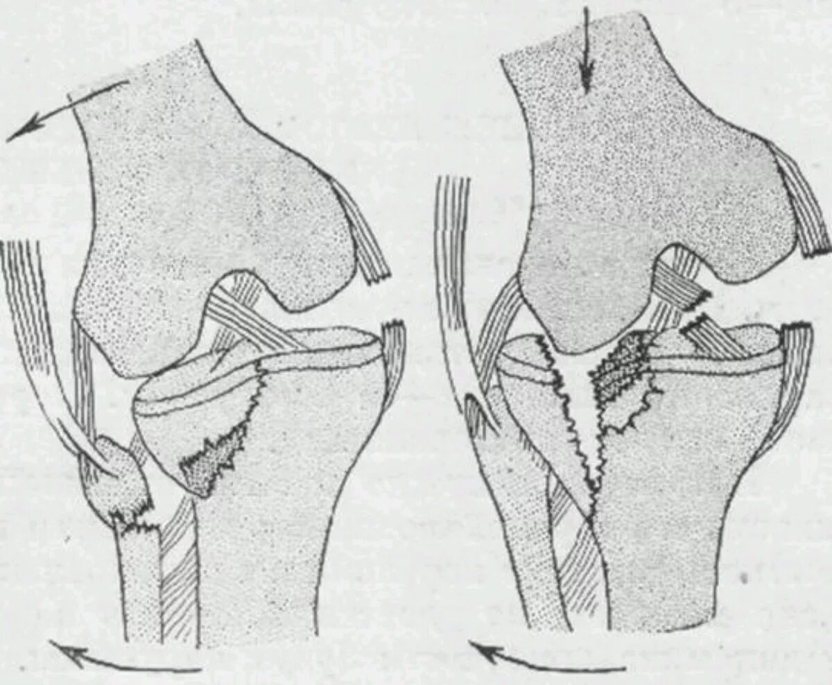 Импрессионный перелом мыщелка бедренной кости. Перелом наружного мыщелка большеберцовой кости. Перелом внутреннего мыщелка большеберцовой кости. Импрессионный перелом коленного сустава.