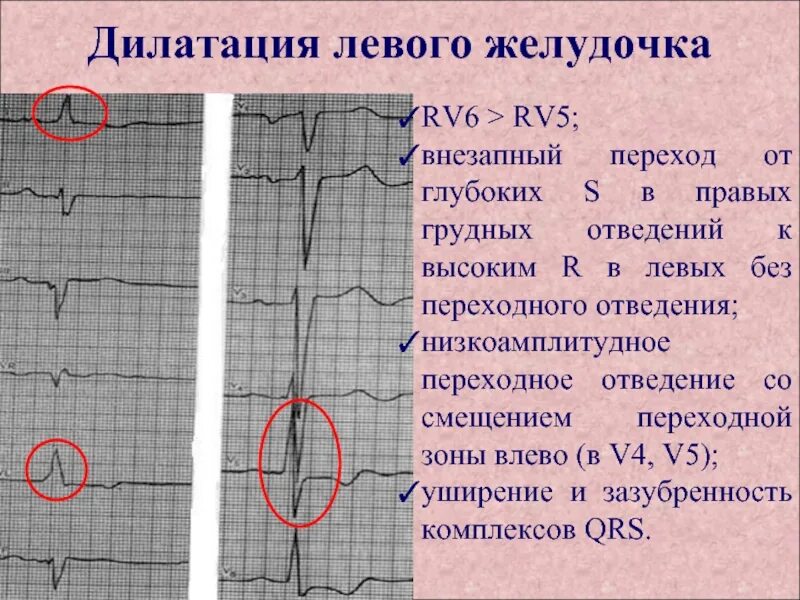 Гипертрофия левого предсердия и правого желудочка на ЭКГ. Дилатация левого желудочка на ЭКГ. Гипертрофия миокарда, предсердий, желудочков. ЭКГ при дилатации левого желудочка. Экг преобладание левого желудочка