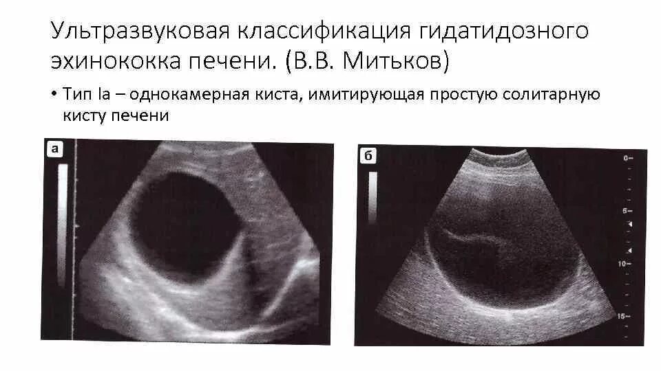 Кисты печени симптомы причины. Эхинококковая киста печени УЗИ. Эхинококкоз печени УЗИ. Эхинококк печени на УЗИ классификация. Эхинококковая киста печени протокол УЗИ.