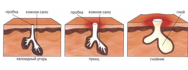 Что приложить чтобы вытянуть гной. Что приложить чтобы вытянуть гной